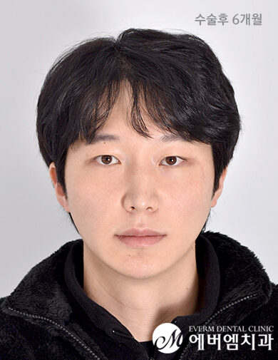 หลัง ZYGOMA