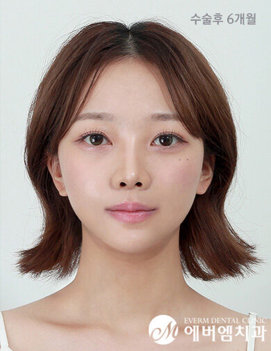 หลังผ่าตัด Double Jaw Surgery + V-Line