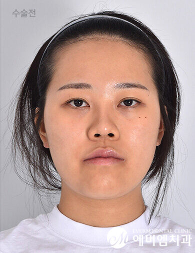 ก่อนผ่าตัด Double Jaw Surgery + V-Line