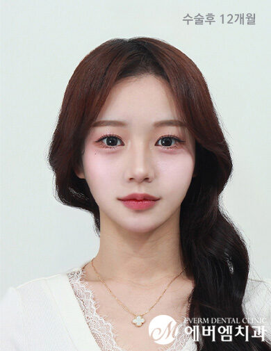 หลังผ่าตัด V-Line Double Jaw Surgery