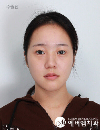 ก่อนผ่าตัด V-Line Double Jaw Surgery