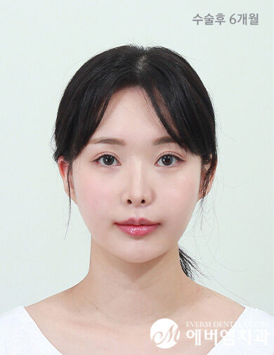 หลังผ่าตัด V-Line Double Jaw Surgery