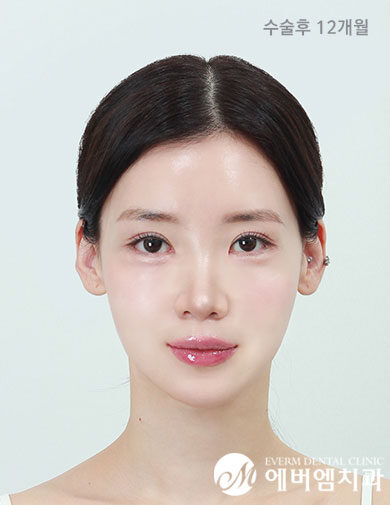 หลังผ่าตัด V-Line Double Jaw Surgery