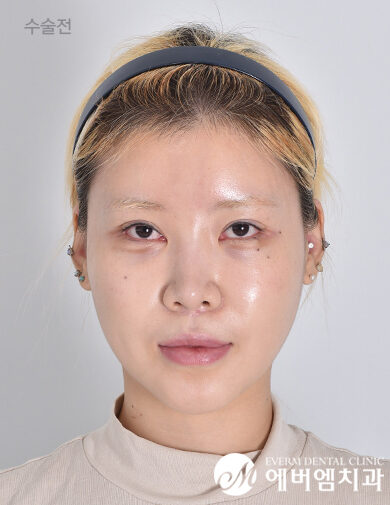 ก่อนผ่าตัด V-Line Double Jaw Surgery