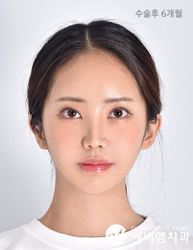หลังผ่าตัด Double Jaw Surgery + 3-Part Contouring
