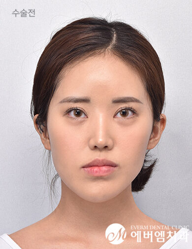 ก่อนผ่าตัด Double Jaw Surgery + 3-Part Contouring