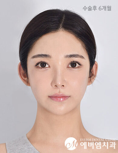 หลังผ่าตัด Double Jaw Surgery + 3-Part Contouring