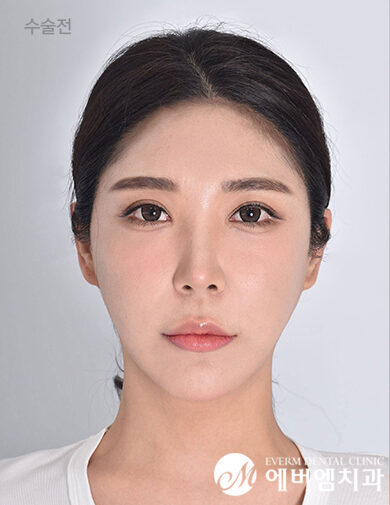 ก่อนผ่าตัด Double Jaw Surgery + 3-Part Contouring