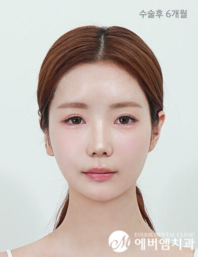 หลังผ่าตัด V-Line Double Jaw Surgery