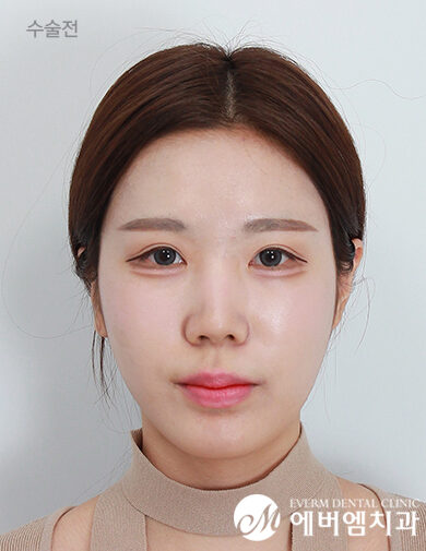 ก่อนผ่าตัด V-Line Double Jaw Surgery