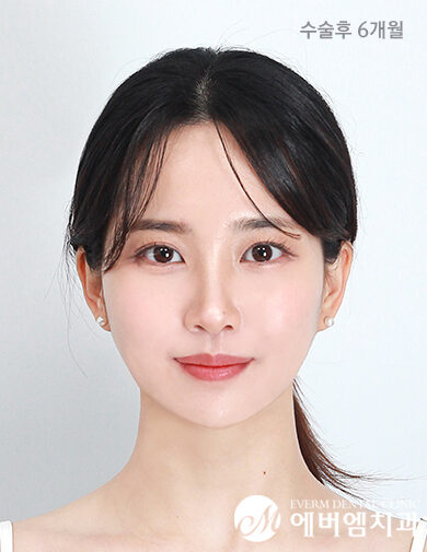 หลังผ่าตัด V-Line Double Jaw Surgery