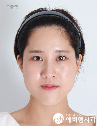 ก่อนผ่าตัด V-Line Double Jaw Surgery