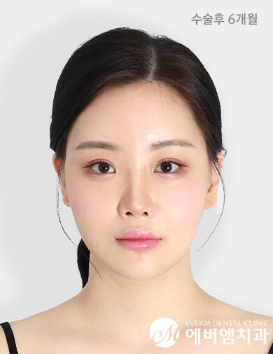 หลังผ่าตัด V-Line Double Jaw Surgery