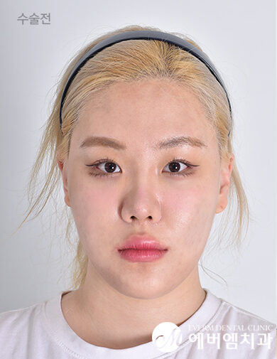 ก่อนผ่าตัด V-Line Double Jaw Surgery