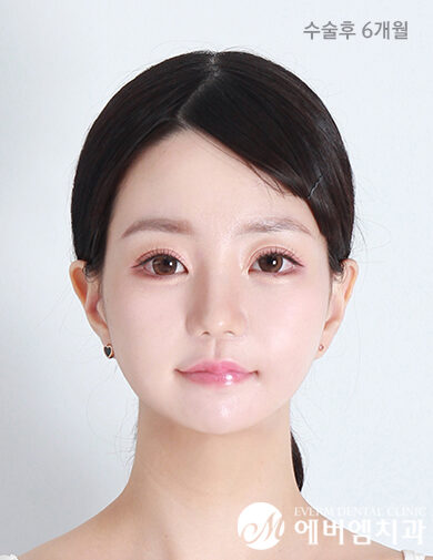หลังผ่าตัด V-Line Double Jaw Surgery