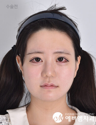 ก่อนผ่าตัด V-Line Double Jaw Surgery