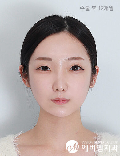หลังผ่าตัด Cheekbone Reduction + V-Line Double Jaw Surgery