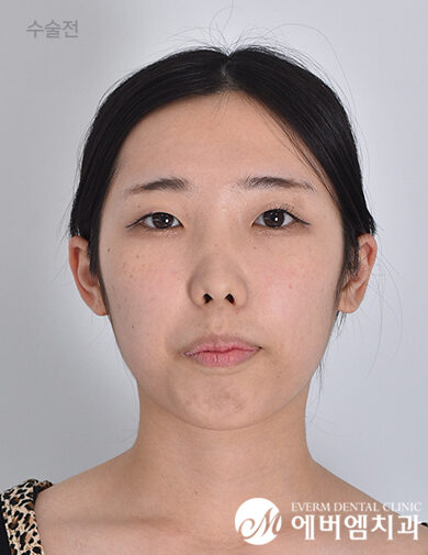 ก่อนผ่าตัด Cheekbone Reduction + V-Line Double Jaw Surgery