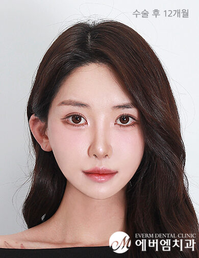 หลังผ่าตัด Double Jaw Surgery + 3-Part Contouring