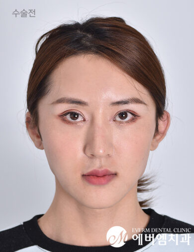 ก่อนผ่าตัด Double Jaw Surgery + 3-Part Contouring