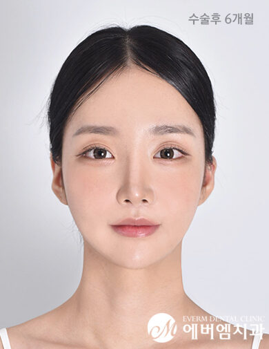 หลังผ่าตัด V-Line Double Jaw Surgery