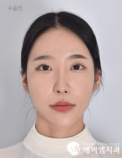 ก่อนผ่าตัด V-Line Double Jaw Surgery