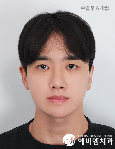 หลังผ่าตัด Chin Surgery + Double Jaw Surgery
