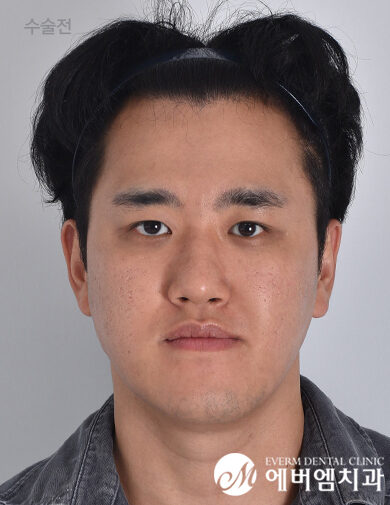 ก่อนผ่าตัด Chin Surgery + Double Jaw Surgery