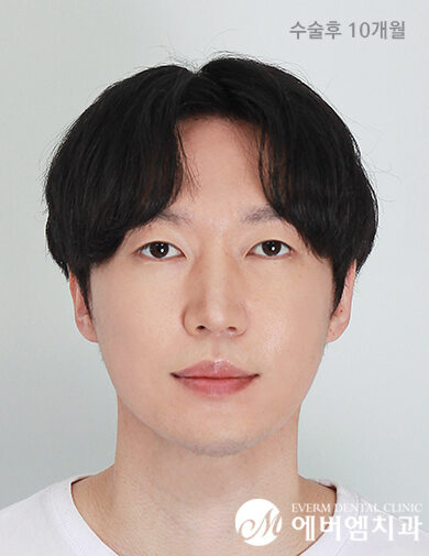 หลังผ่าตัด V-Line + Cheekbone Reduction + Double Jaw Surgery