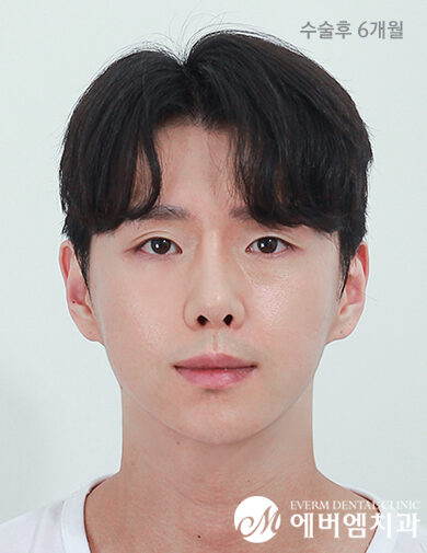 หลังผ่าตัด Cheekbone Reduction + Chin Surgery + Double Jaw Surgery