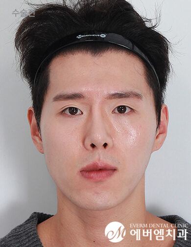 ก่อนผ่าตัด Cheekbone Reduction + Chin Surgery + Double Jaw Surgery