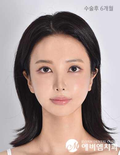 หลังผ่าตัด V-Line Double Jaw Surgery