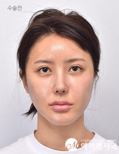 ก่อนผ่าตัด V-Line Double Jaw Surgery