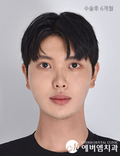หลังผ่าตัด Double Jaw Surgery + V-Line