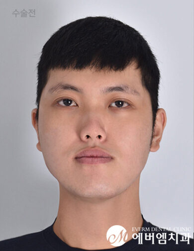 ก่อนผ่าตัด Double Jaw Surgery + V-Line