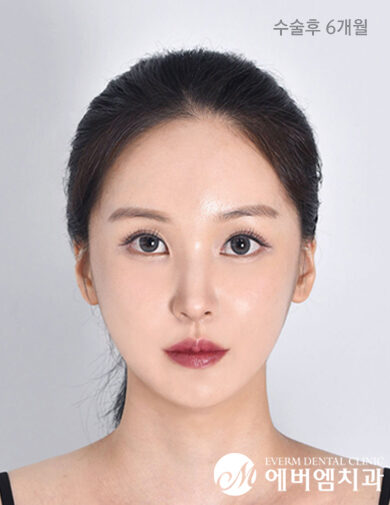หลังผ่าตัด Cheekbone Reduction + V-Line Double Jaw Surgery