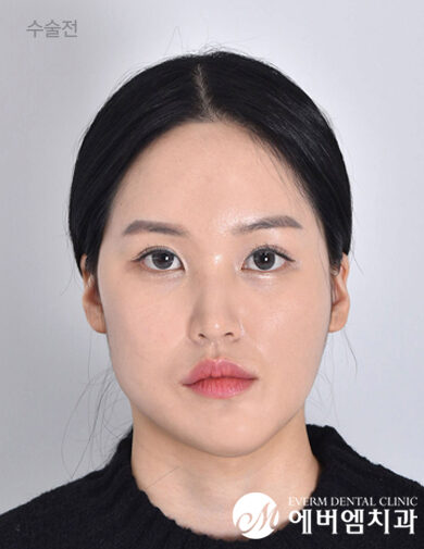 ก่อนผ่าตัด Cheekbone Reduction + V-Line Double Jaw Surgery