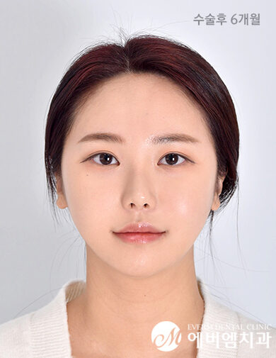 หลังผ่าตัด Double Jaw Surgery + 3-Part Contouring