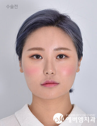 ก่อนผ่าตัด Double Jaw Surgery + 3-Part Contouring