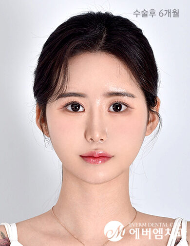 หลังผ่าตัด V-Line Double Jaw Surgery