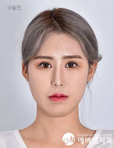 ก่อนผ่าตัด V-Line Double Jaw Surgery