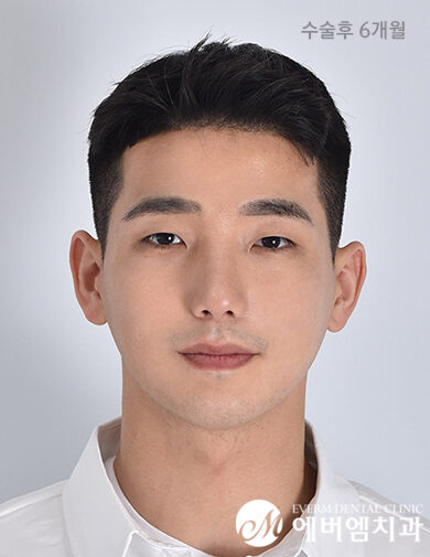 หลังผ่าตัด V-Line Double Jaw Surgery