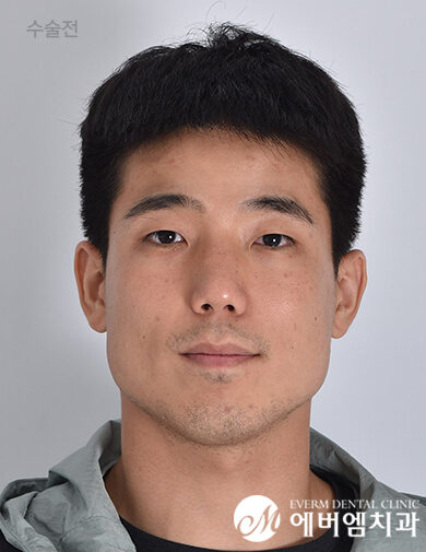 ก่อนผ่าตัด V-Line Double Jaw Surgery