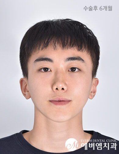 หลังผ่าตัด Double Jaw + Chin Surgery