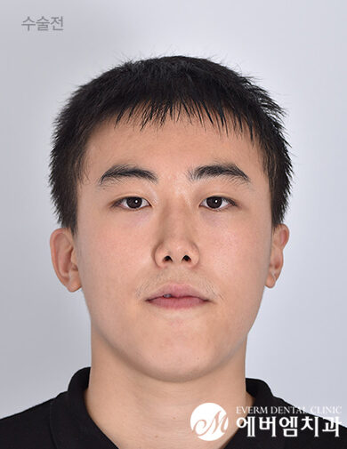 ก่อนผ่าตัด Double Jaw + Chin Surgery