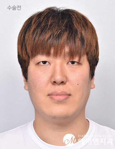 ก่อนผ่าตัด V-Line Double Jaw Surgery