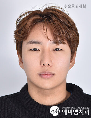 หลังผ่าตัด V-Line Double Jaw Surgery