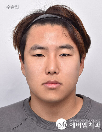 ก่อนผ่าตัด V-Line Double Jaw Surgery