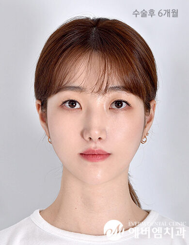 หลังผ่าตัด V-Line Double Jaw Surgery
