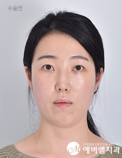ก่อนผ่าตัด V-Line Double Jaw Surgery